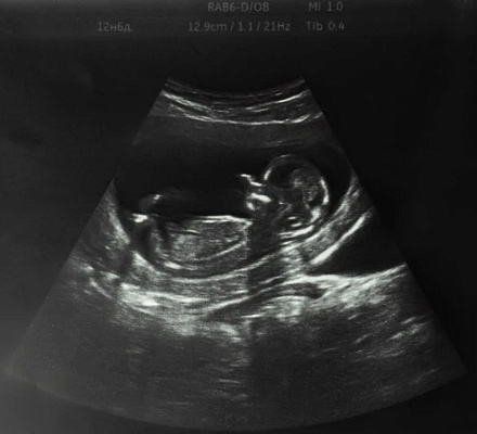 Законы о защите жизни не способствуют росту числа младенческих смертей, считает эксперт в области акушерства и гинекологии